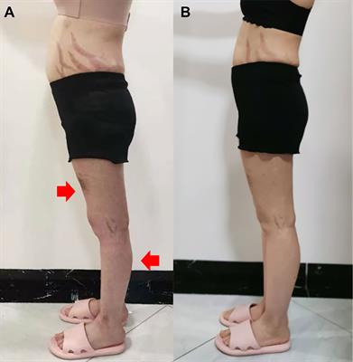 Concurrence of osteonecrosis and steroid myopathy secondary to oral steroid therapy in a patient with ABCB1 gene polymorphisms: A case report